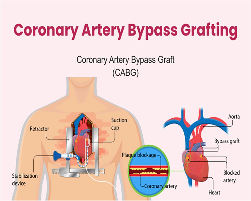 Coronary Artery Bypass Grafting CABG 